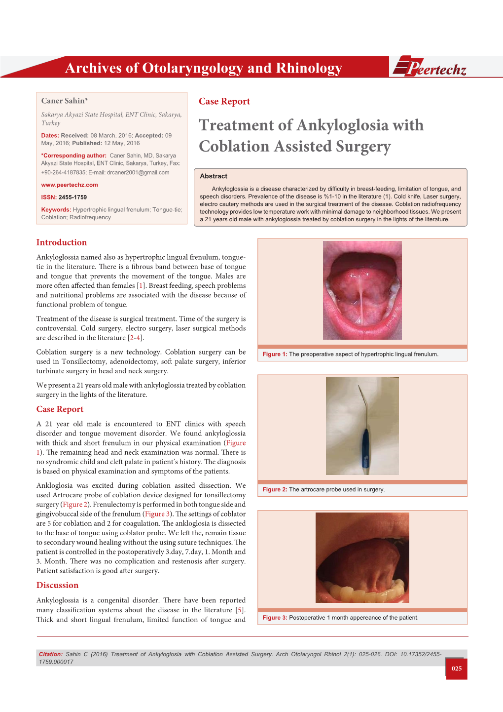 Treatment of Ankyloglosia with Coblation Assisted Surgery