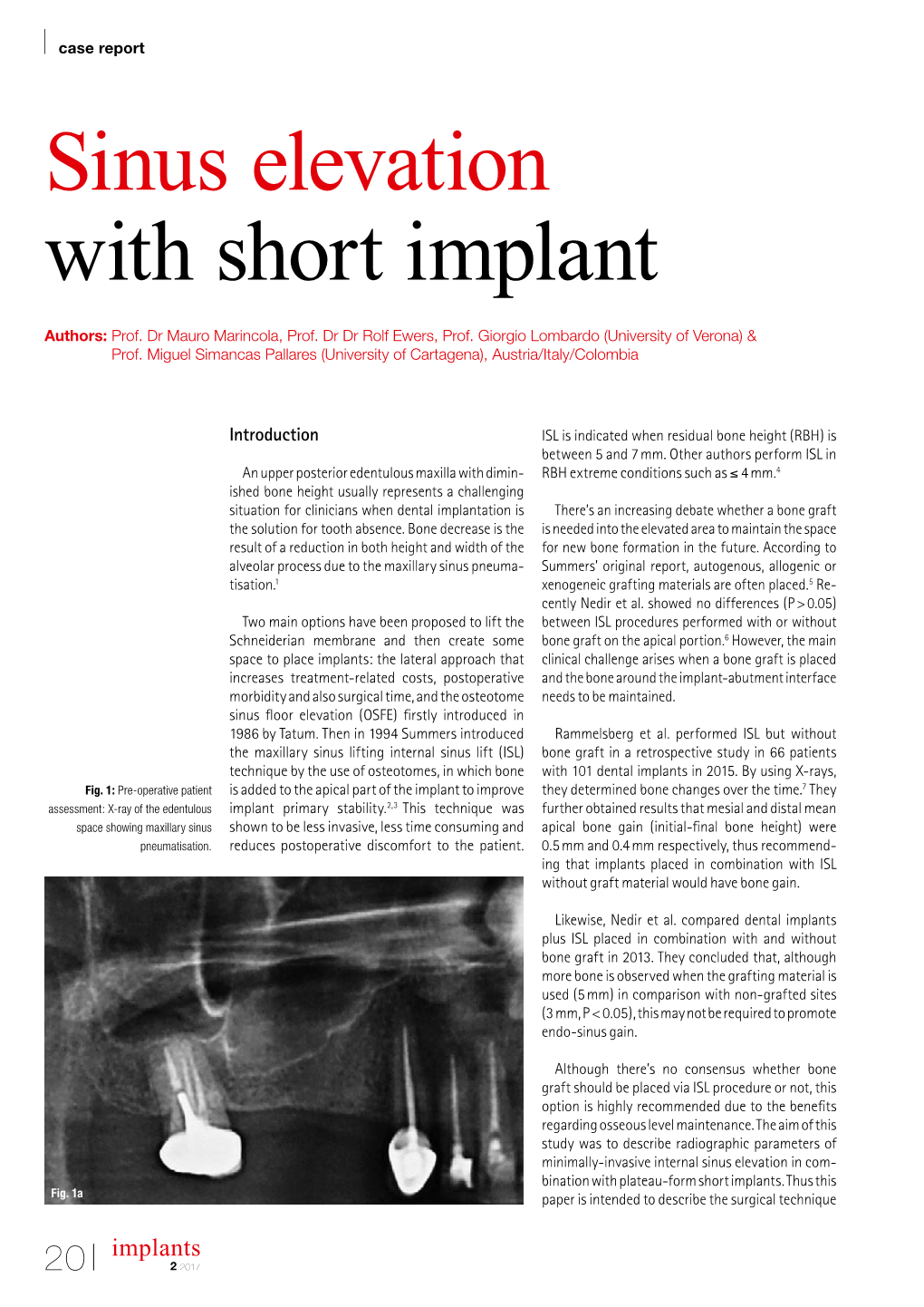 Sinus Elevation with Short Implant