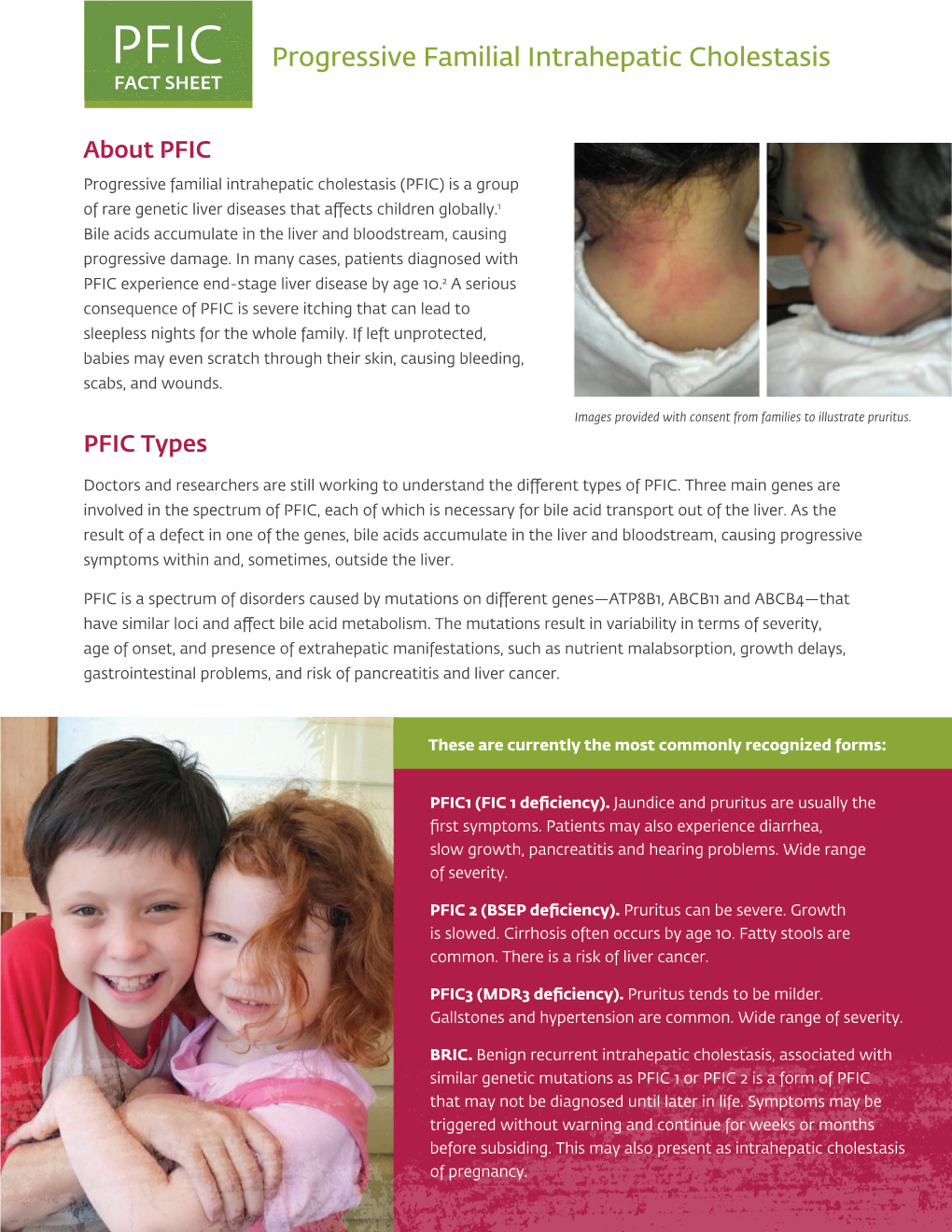 Progressive Familial Intrahepatic Cholestasis FACT SHEET - DocsLib