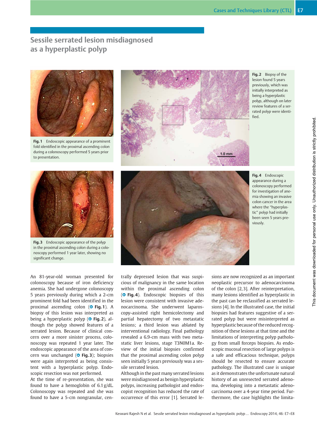 Sessile Serrated Lesion Misdiagnosed As a Hyperplastic Polyp