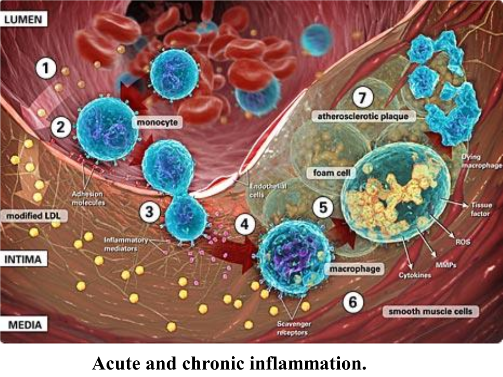 Acute and Chronic Inflammation. Acute and Chronic Inflammation