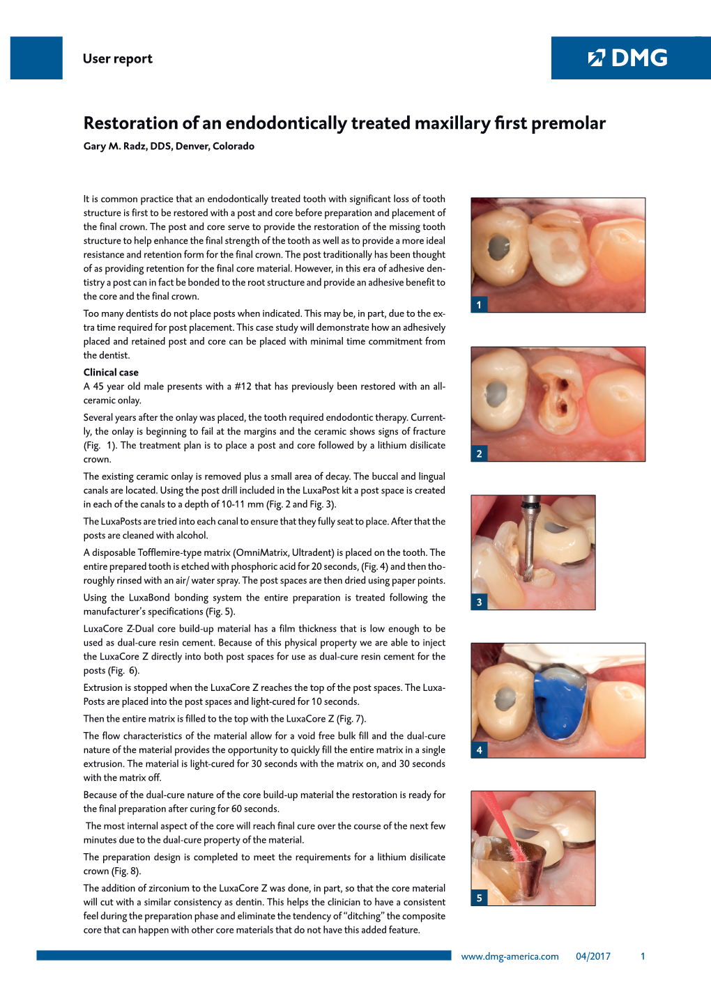 Restoration of an Endodontically Treated Maxillary First Premolar Gary M