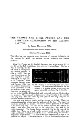 The Venous and Liver Pulses, and the Arhythmic Contraction of the Cardiac Cavities