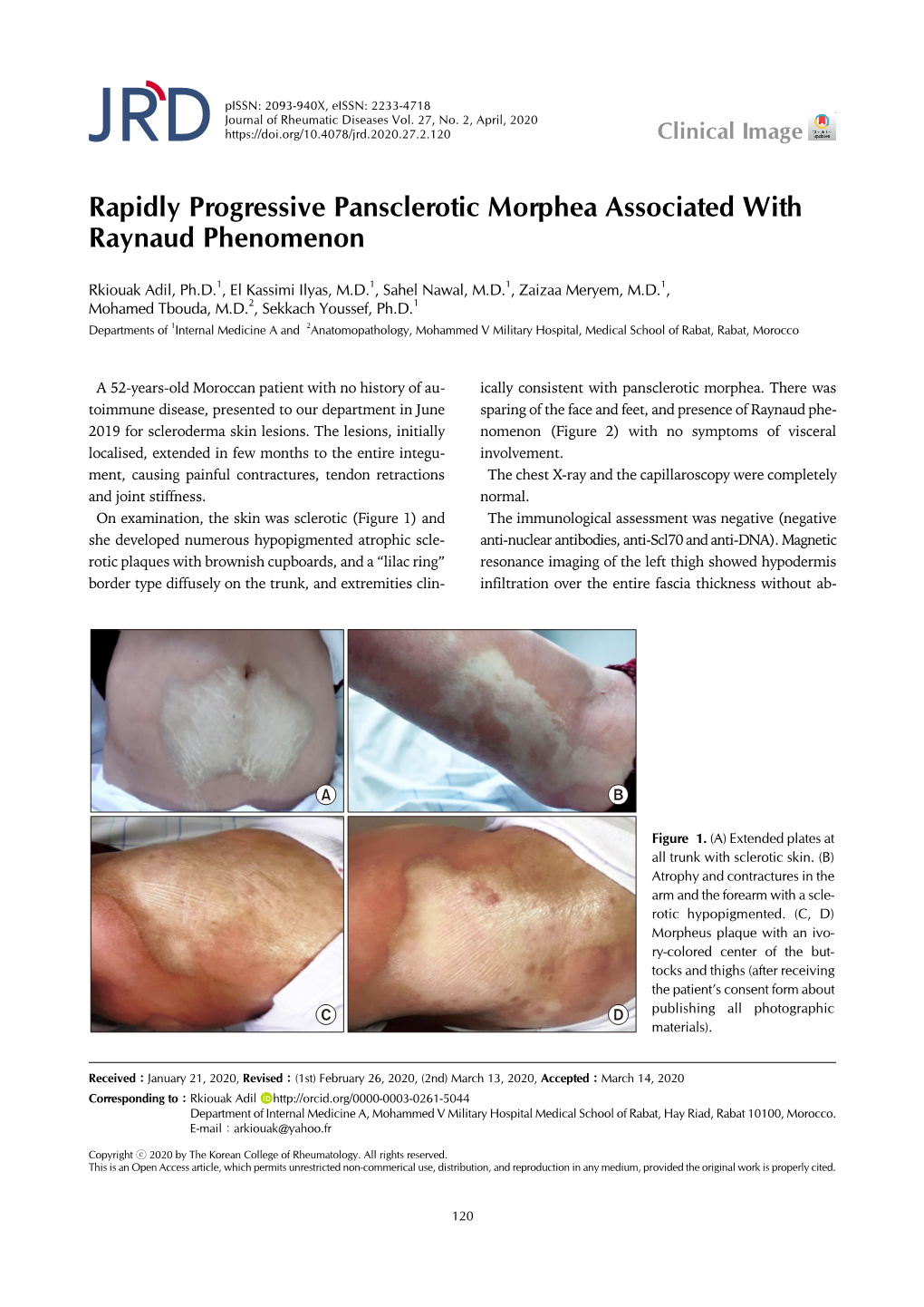 Rapidly Progressive Pansclerotic Morphea Associated with Raynaud Phenomenon