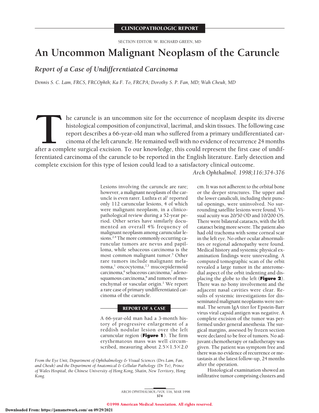 An Uncommon Malignant Neoplasm of the Caruncle Report of a Case of Undifferentiated Carcinoma