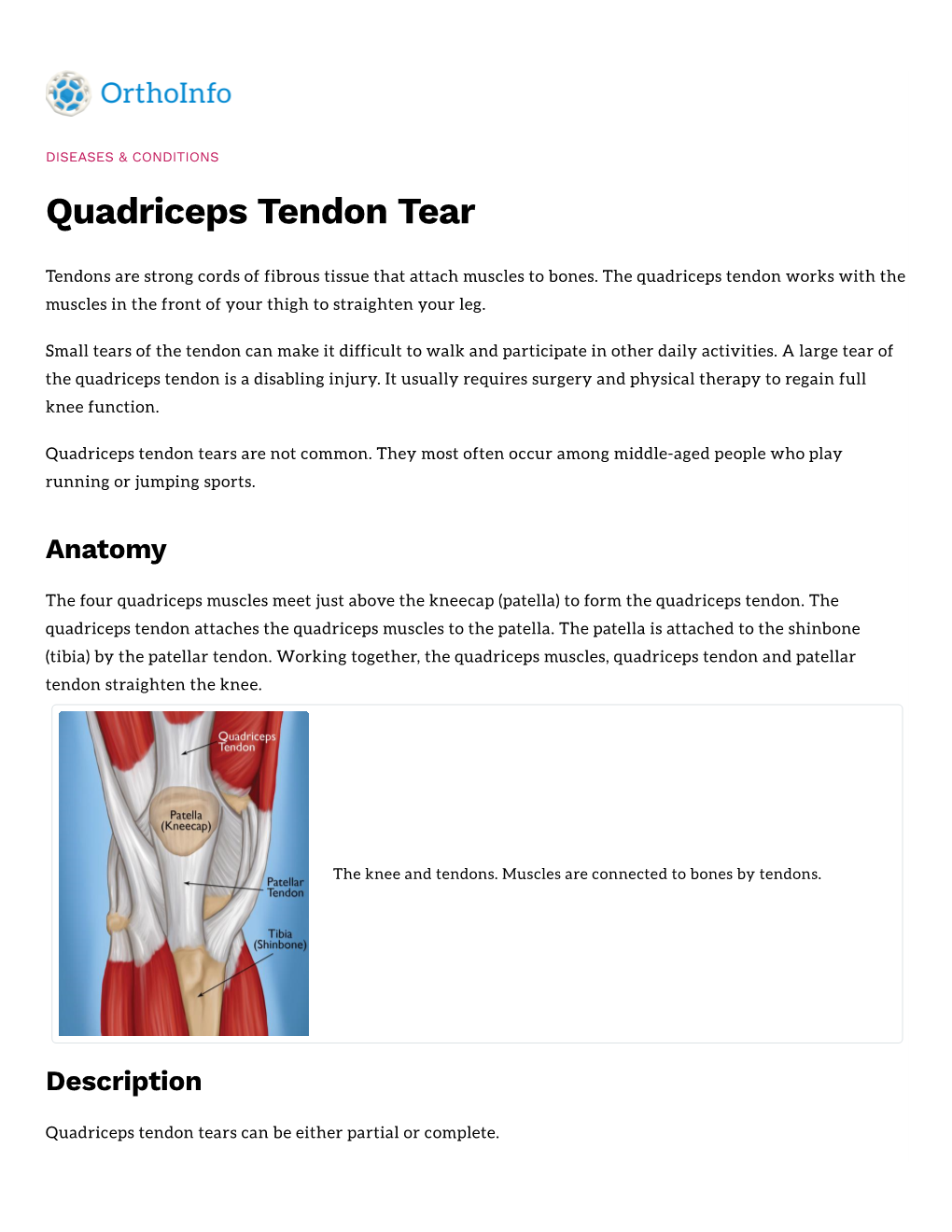 Quadriceps Tendon Tear