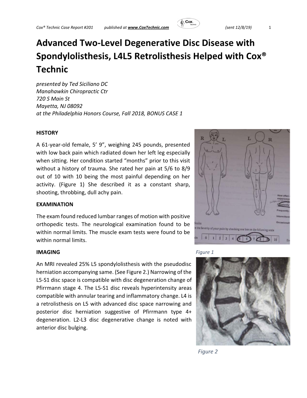 Advanced Two‐Level Degenerative Disc Disease with Spondylolisthesis, L4L5 Retrolisthesis Helped with Cox® Techn