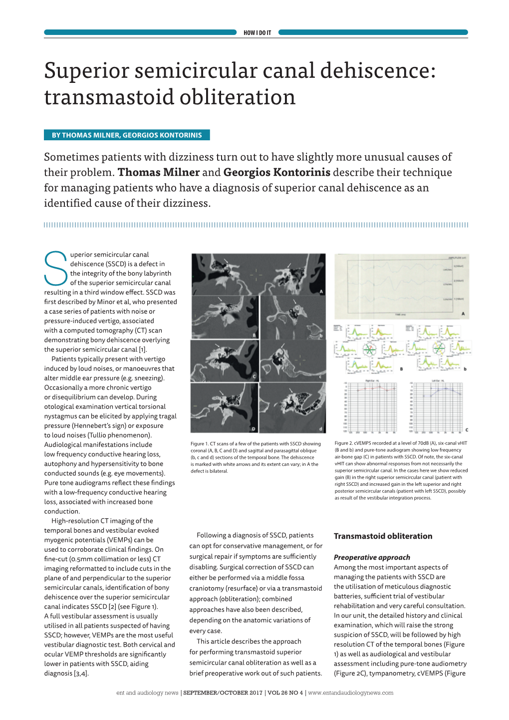 Superior Semicircular Canal Dehiscence: Transmastoid Obliteration