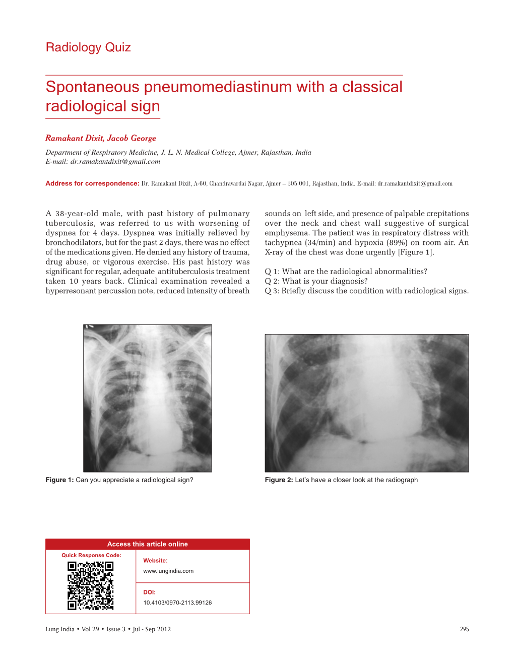 Spontaneous Pneumomediastinum with a Classical Radiological Sign
