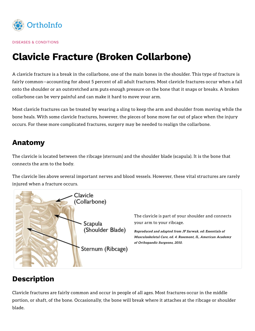 Clavicle Fracture (Broken Collarbone)