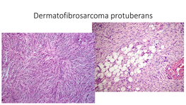 Dermatofibrosarcoma Protuberans Dermatofibrosarcoma Protuberans Storiform Collagenoma