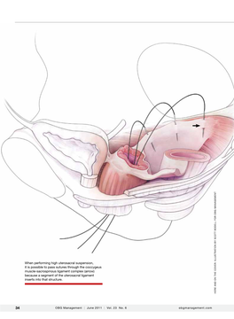When Performing High Uterosacral Suspension, It Is Possible to Pass Sutures Through the Coccygeus Er: Illustrat Ov