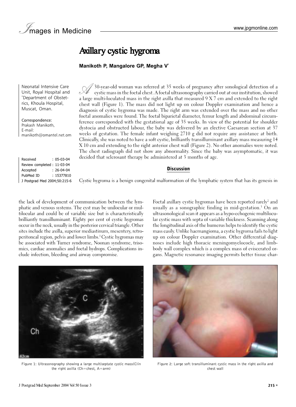 Axillary Cystic Hygroma