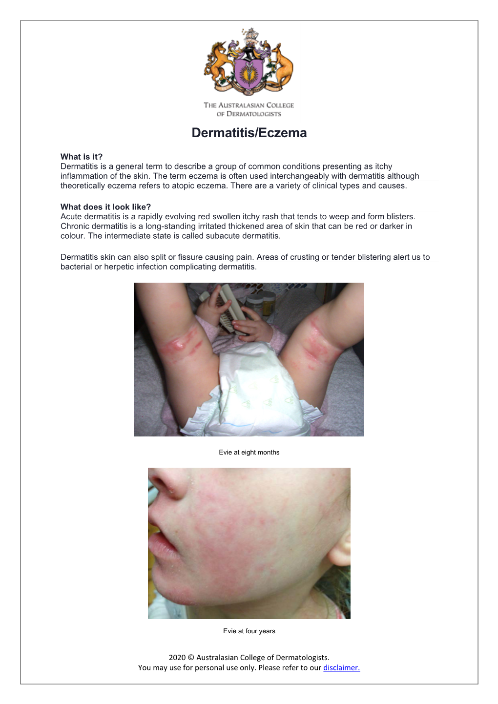 Dermatitis/Eczema