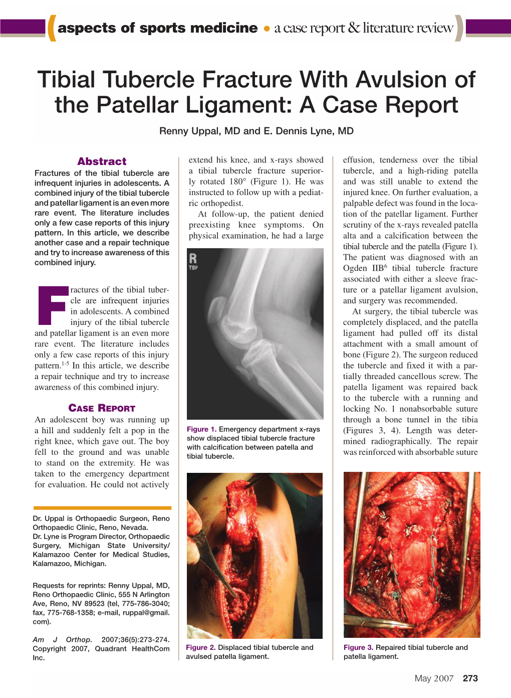 Treatment Of Tibial Tubercle Avulsion Fracture Downlo Vrogue Co