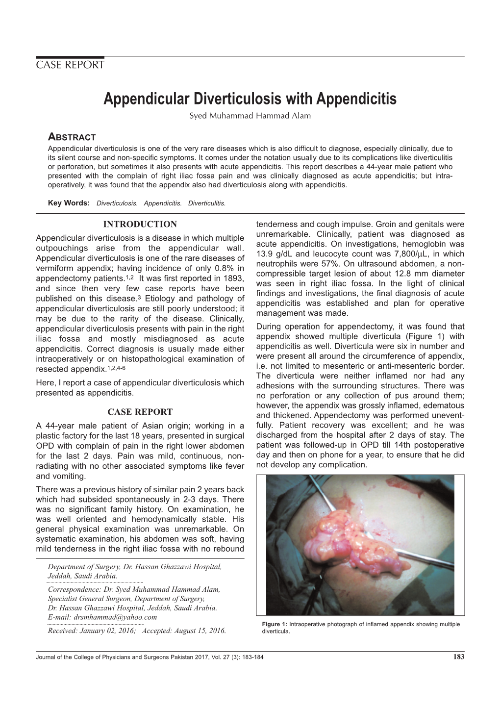 Appendicular Diverticulosis With Appendicitis Syed Muhammad Hammad Alam