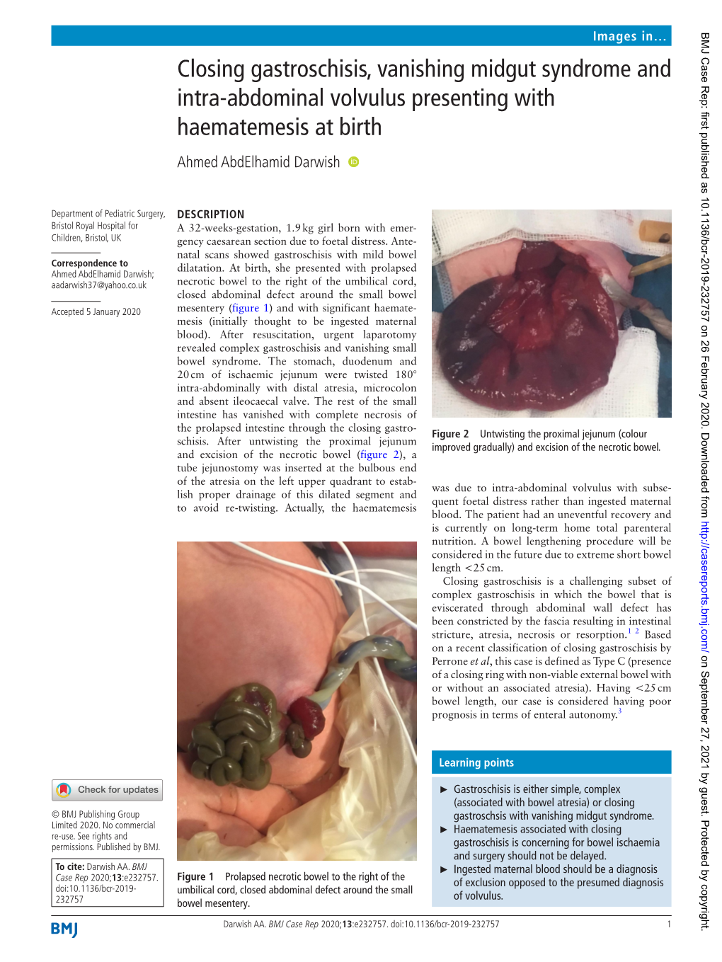 Closing Gastroschisis, Vanishing Midgut Syndrome and Intra-­Abdominal Volvulus Presenting with Haematemesis at Birth Ahmed Abdelhamid Darwish ‍ ‍