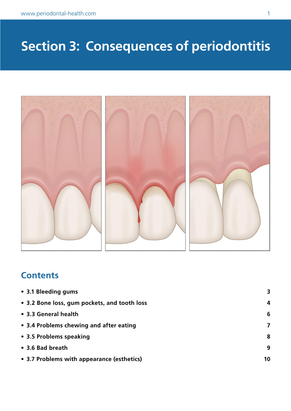 Consequences of Periodontitis