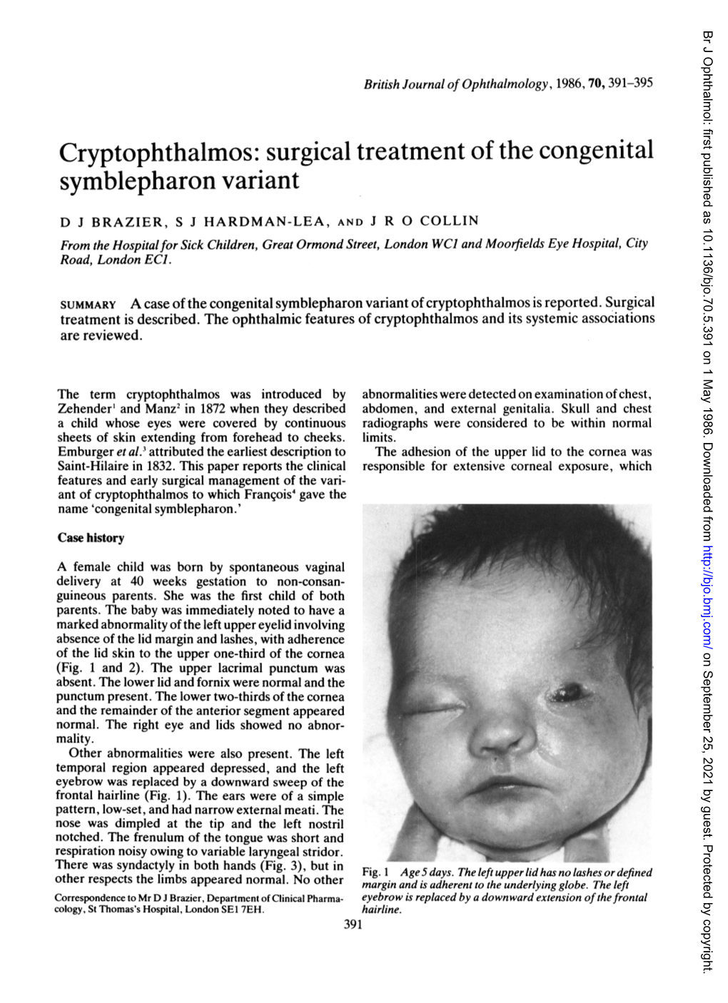 Cryptophthalmos: Surgical Treatment of the Congenital Symblepharon Variant