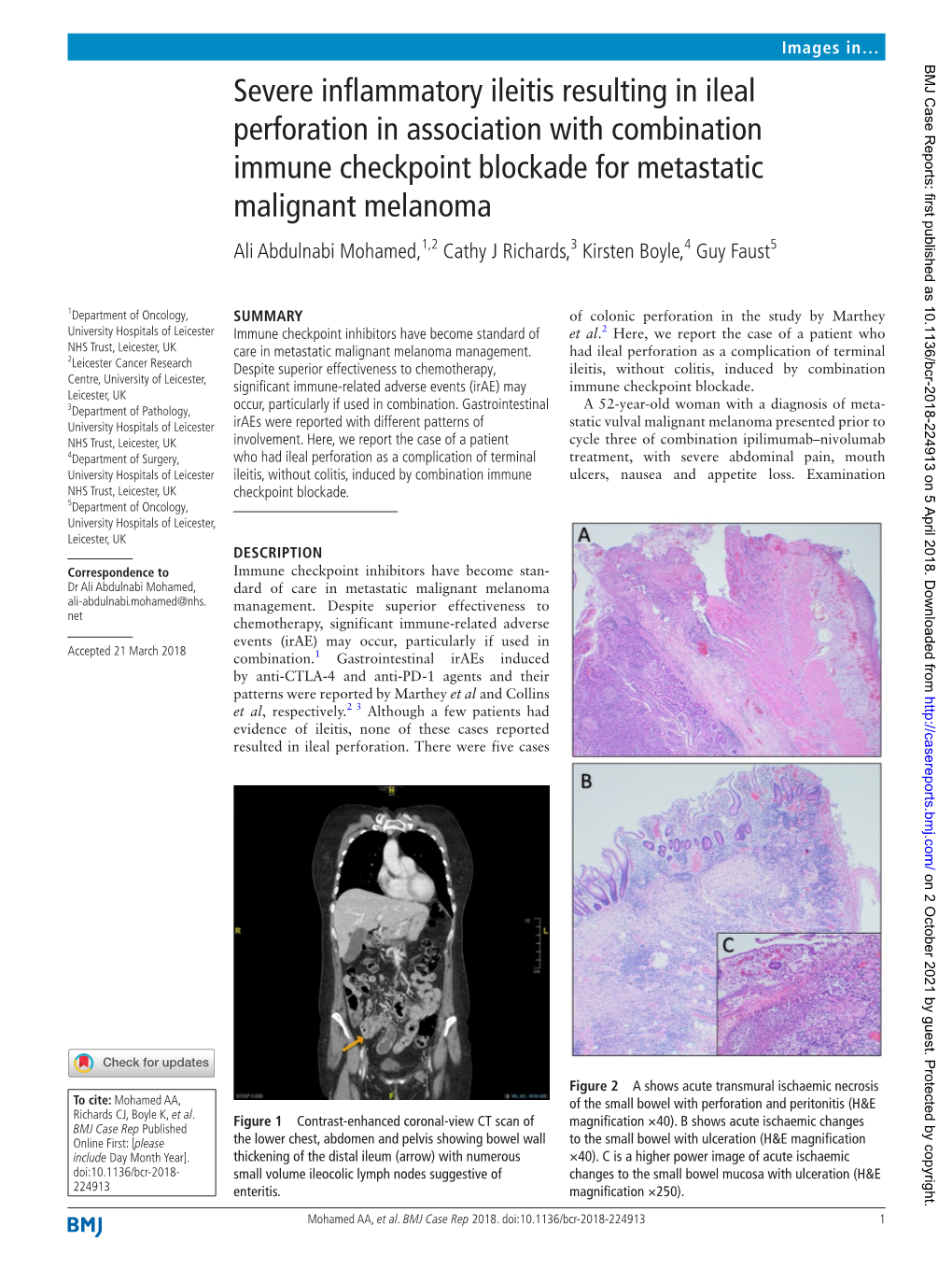 Severe Inflammatory Ileitis Resulting in Ileal Perforation in Association With