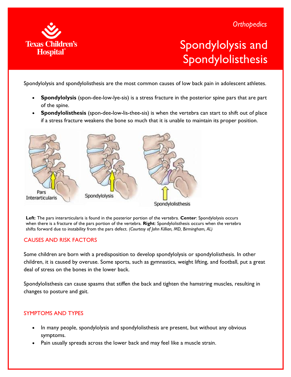 Spondylolysis and Spondylolisthesis