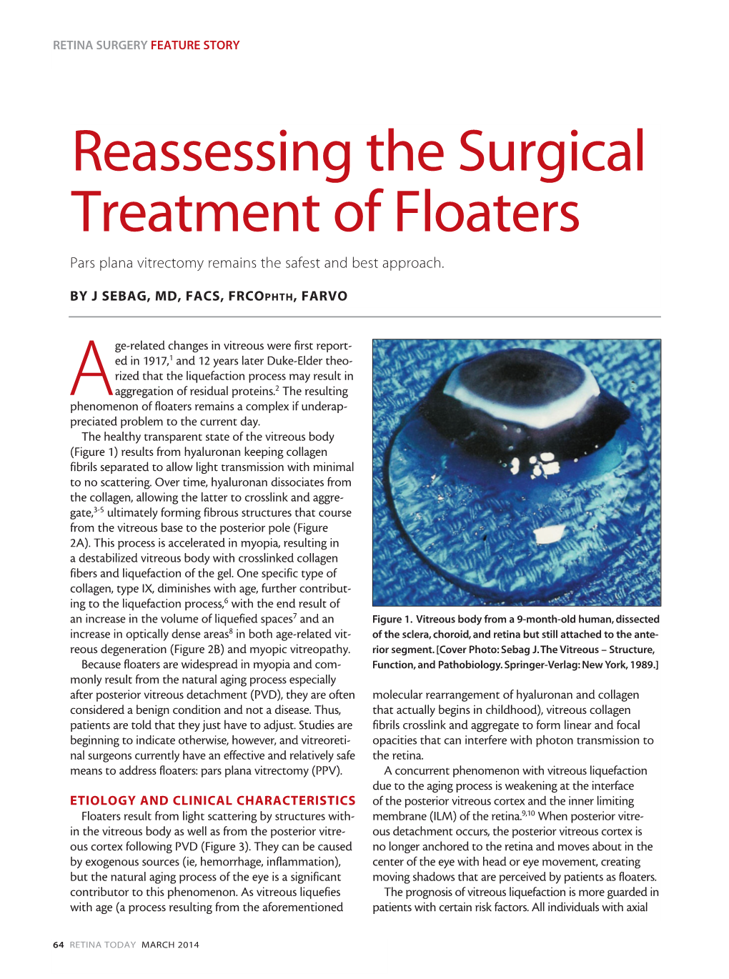 Reassessing the Surgical Treatment of Floaters Pars Plana Vitrectomy Remains the Safest and Best Approach