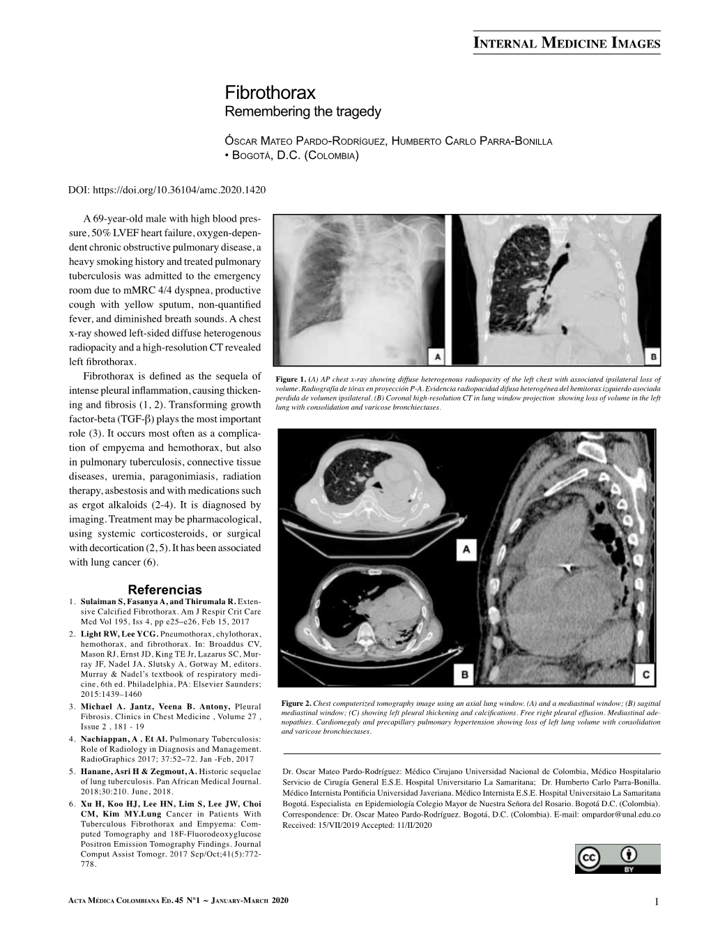 Fibrothorax Remembering the Tragedy