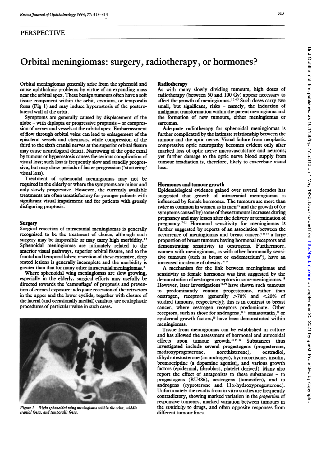 Orbital Meningiomas: Surgery, Radiotherapy, Or Hormones?