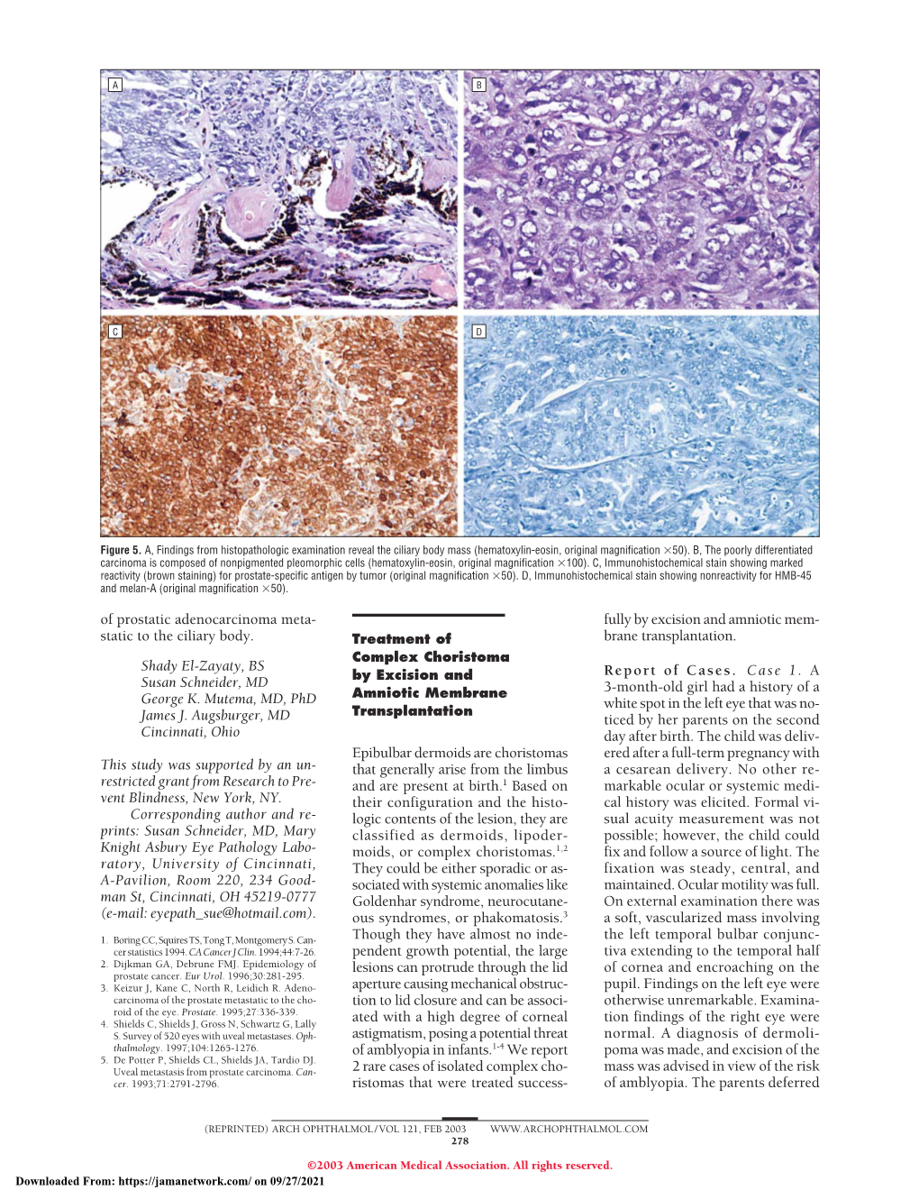 Treatment of Complex Choristoma by Excision and Amniotic Membrane