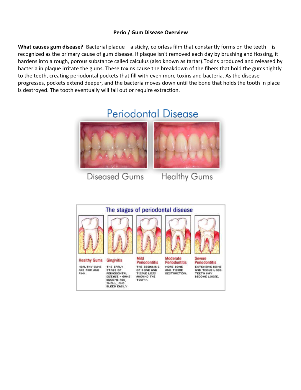 Perio / Gum Disease Overview