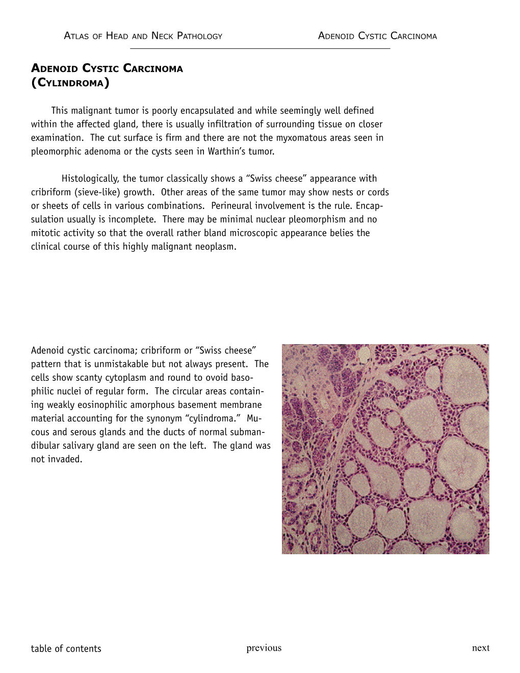 Adenoid Cystic Carcinoma