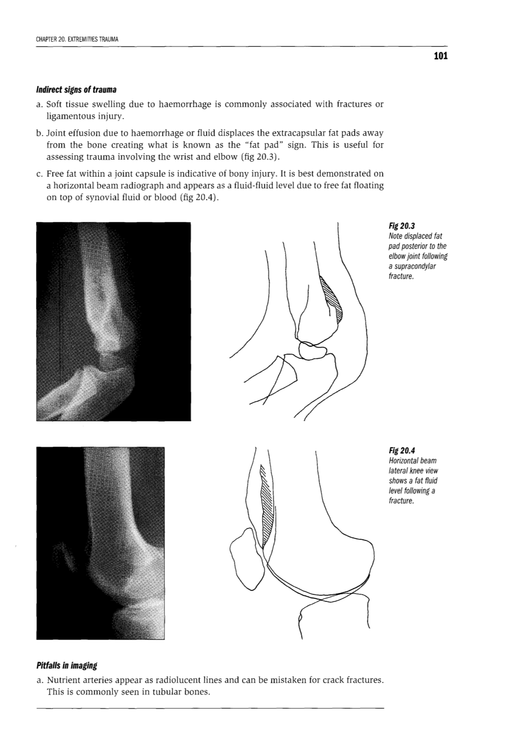 Indirect Signs of Trauma A. Soft Tissue Swelling Due to Haemorrhage Is Commonly Associated with Fractures Or Ligamentous Injury