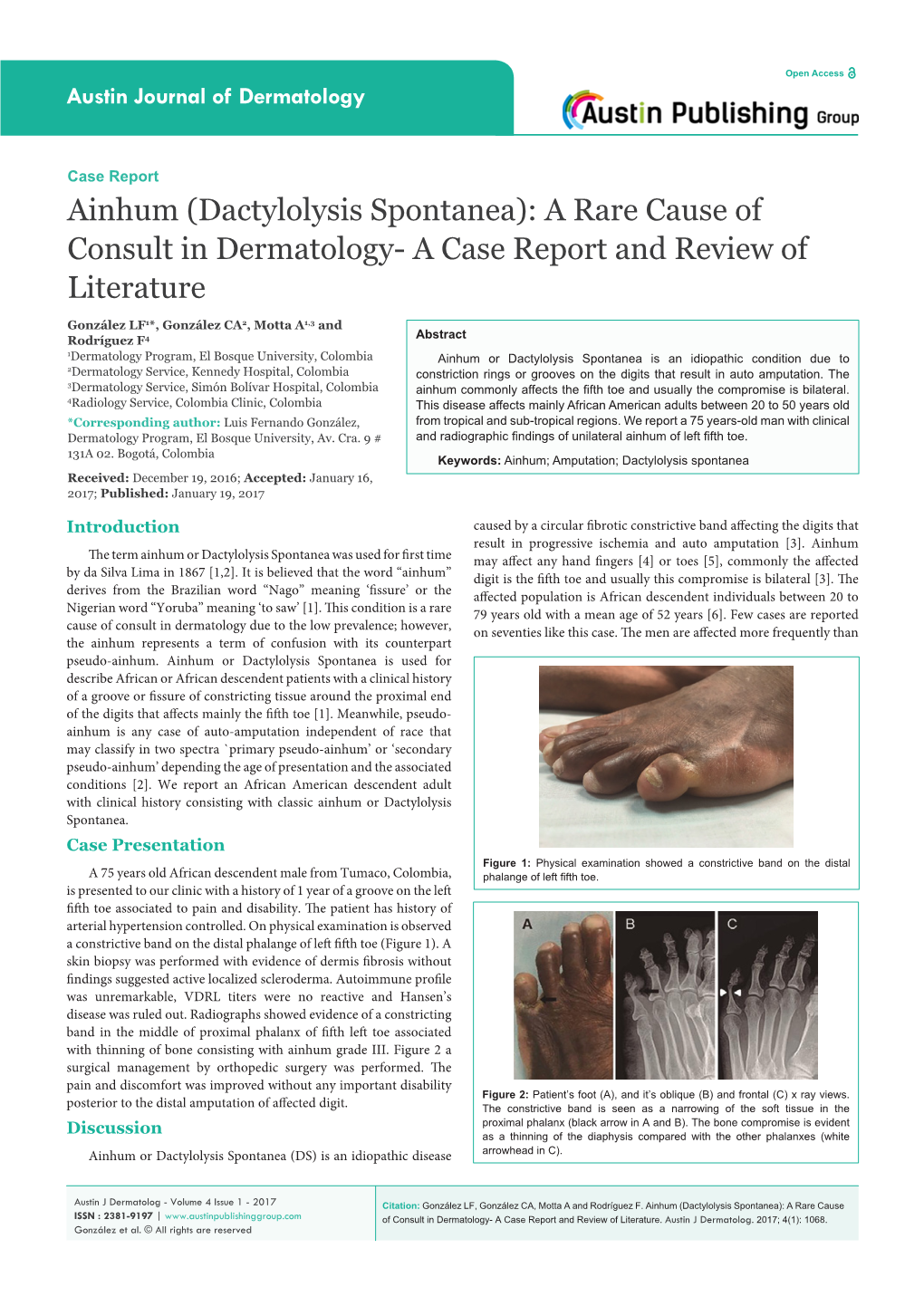 Dactylolysis Spontanea): a Rare Cause of Consult in Dermatology- a Case Report and Review of Literature