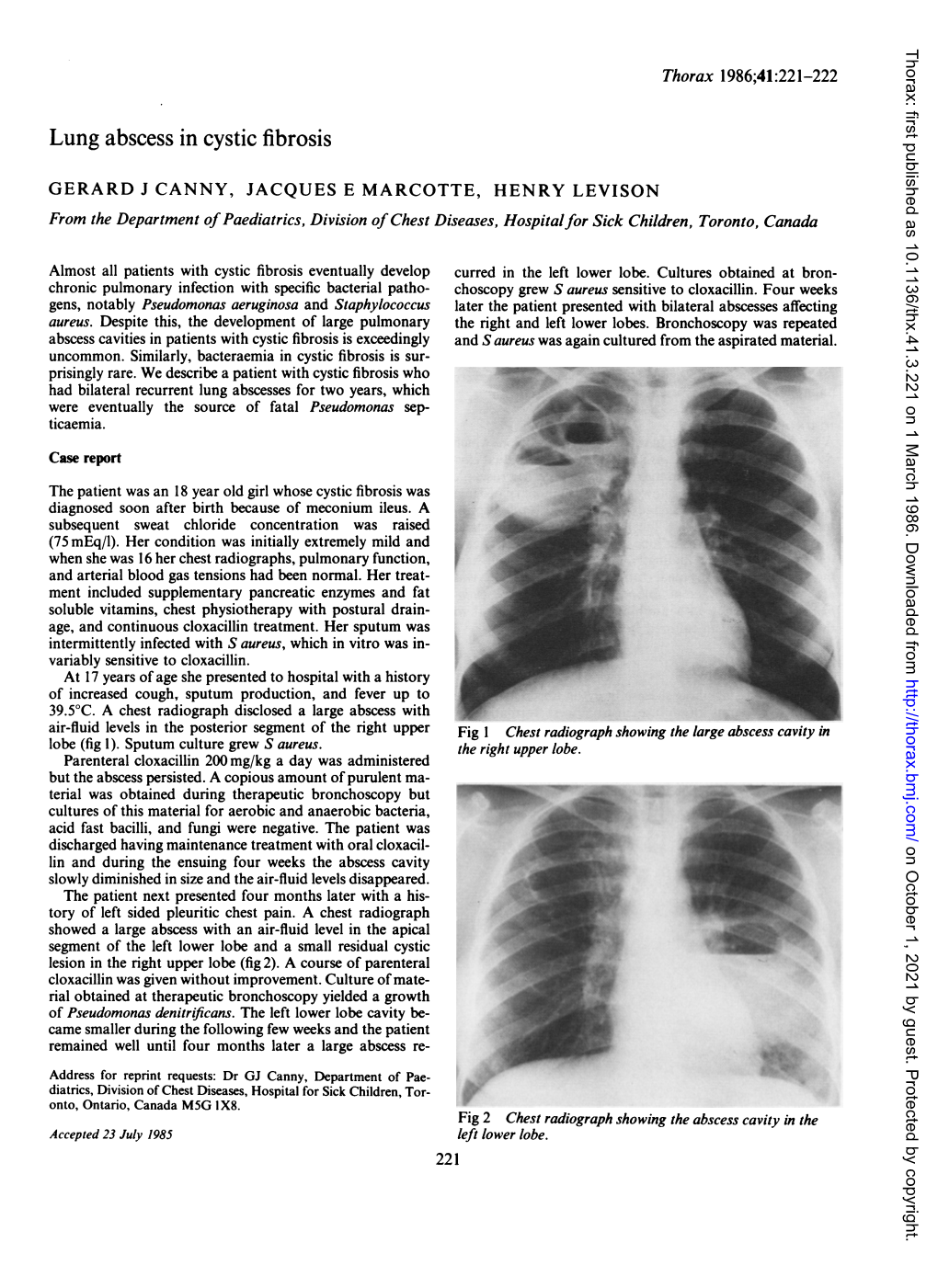 Lung Abscess in Cystic Fibrosis