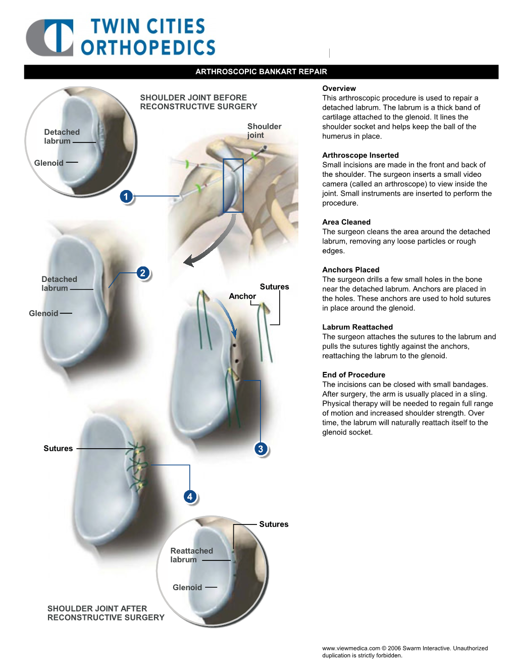 Arthroscopic Bankart Repair