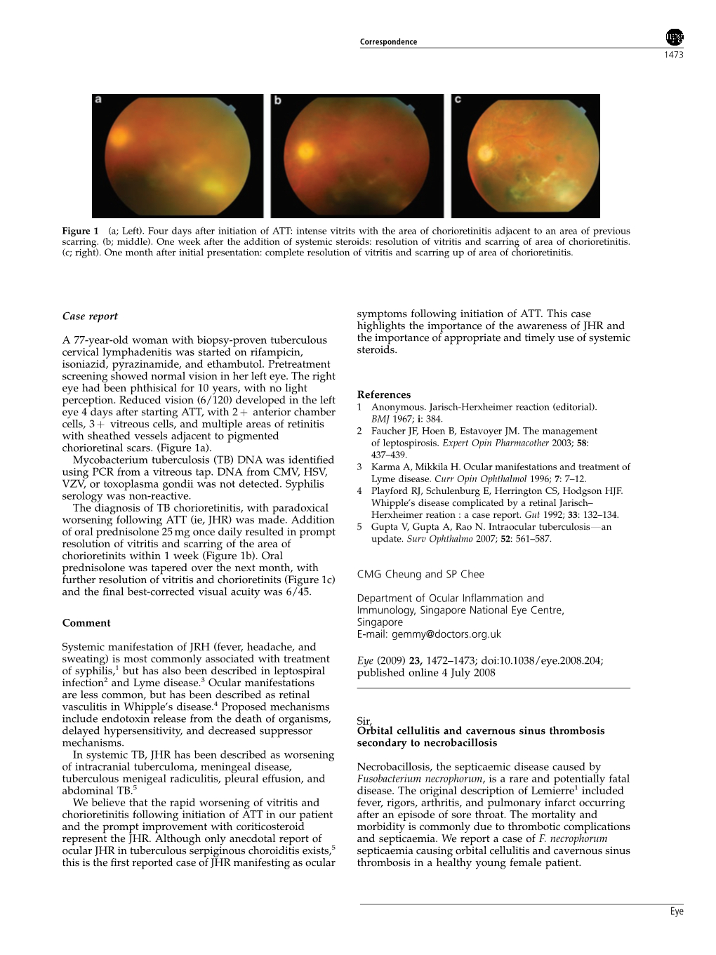 Orbital Cellulitis and Cavernous Sinus Thrombosis Secondary To