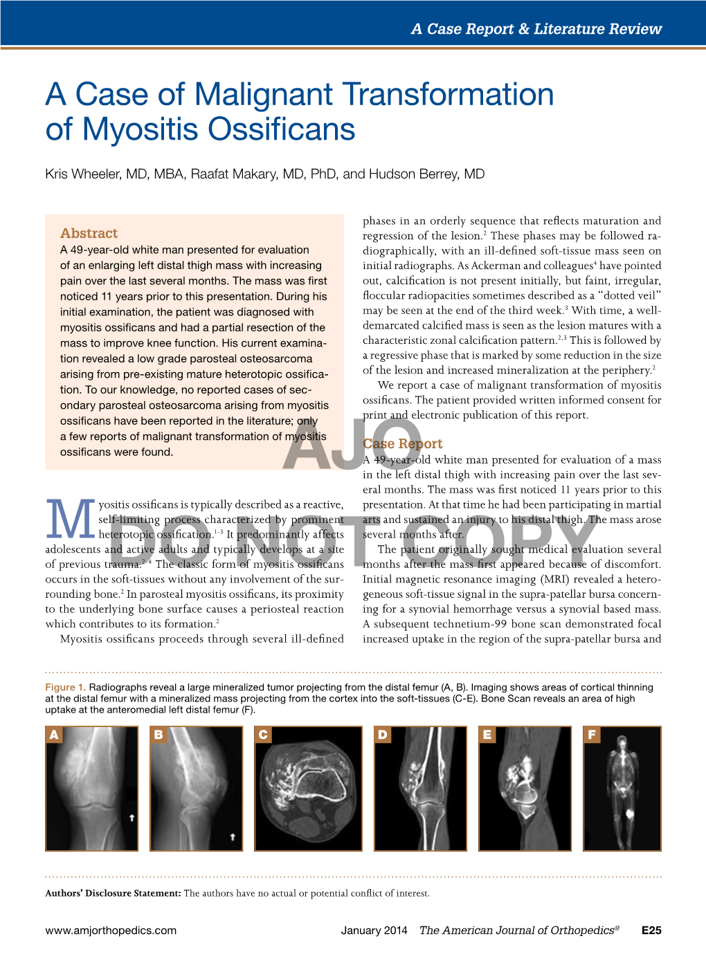 A Case of Malignant Transformation of Myositis Ossificans