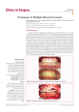 Treatment of Multiple Buccal Exostosis