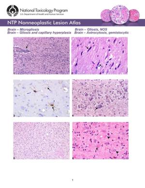 Microgliosis Brain – Gliosis and Capillary Hyperplasia Brain