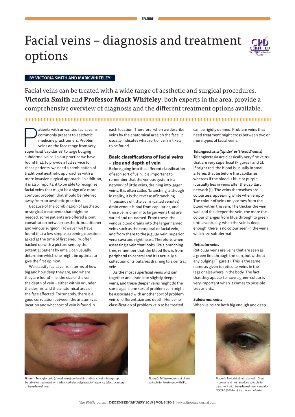 Facial Veins – Diagnosis and Treatment Options