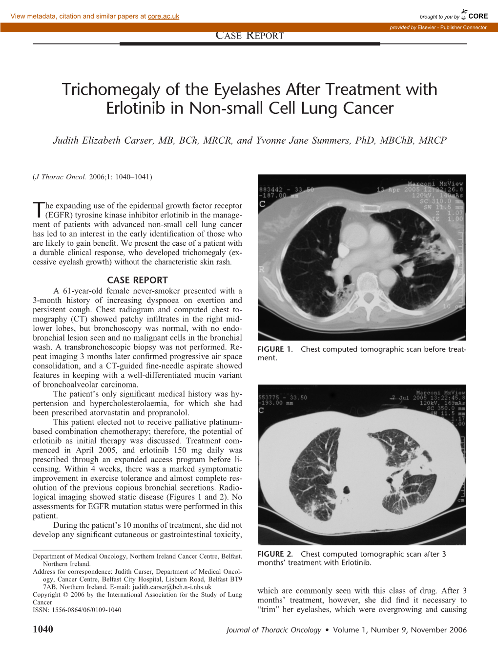 Trichomegaly of the Eyelashes After Treatment with Erlotinib in Non-Small Cell Lung Cancer