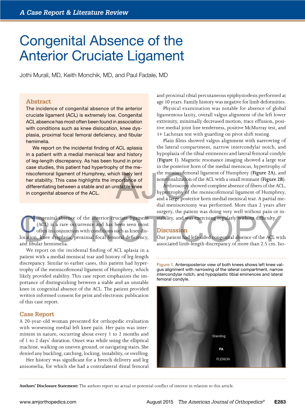 Congenital Absence of the Anterior Cruciate Ligament