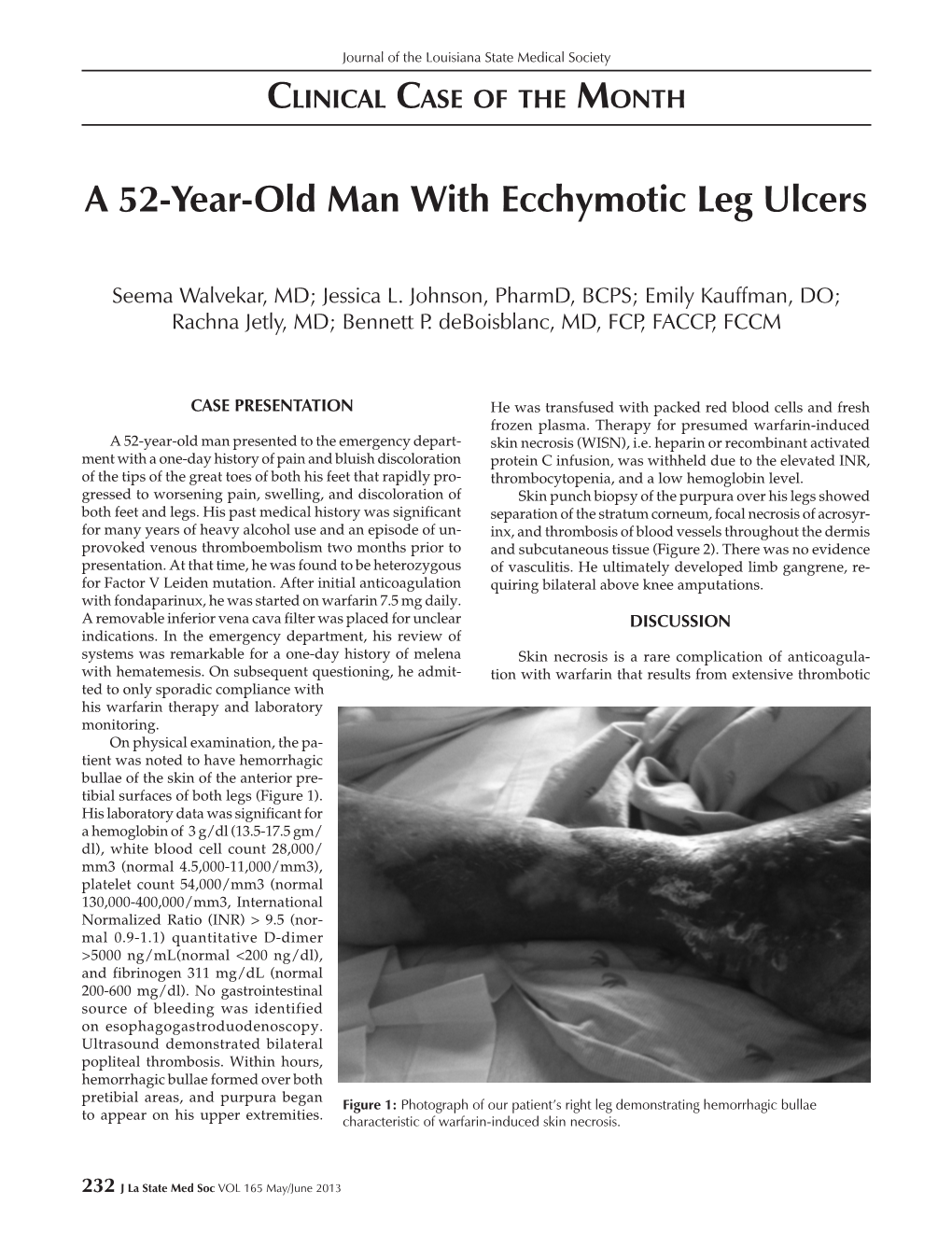 A 52-Year-Old Man with Ecchymotic Leg Ulcers