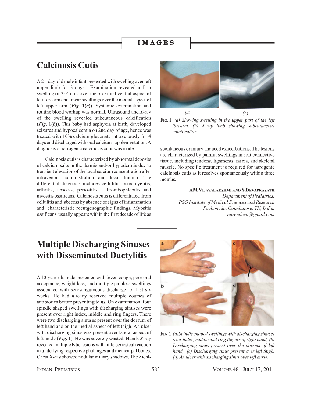 Calcinosis Cutis Multiple Discharging Sinuses with Disseminated Dactylitis