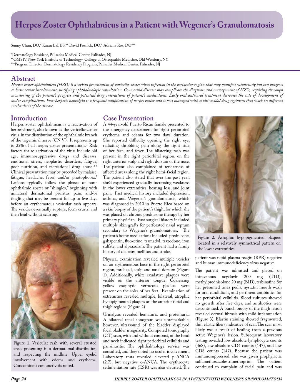 Herpes Zoster Ophthalmicus in a Patient with Wegener's