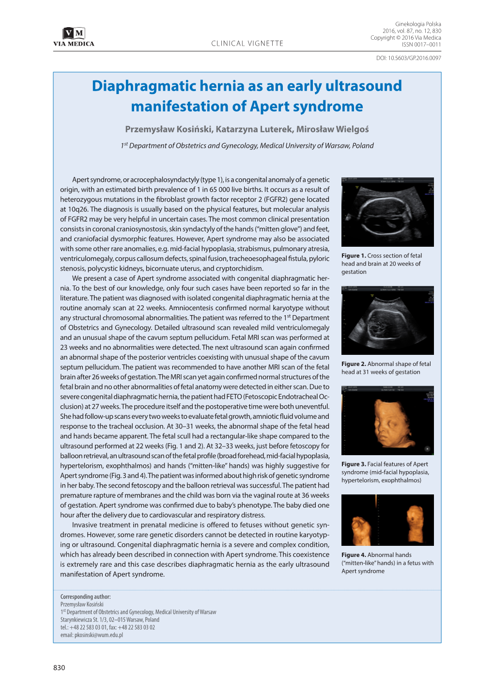 Diaphragmatic Hernia As an Early Ultrasound Manifestation of Apert Syndrome