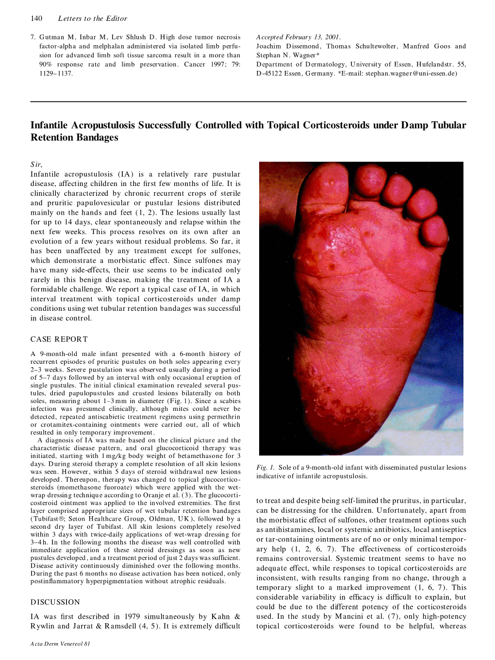 Infantile Acropustulosis Successfully Controlled with Topical Corticosteroids Under Damp Tubular Retention Bandages