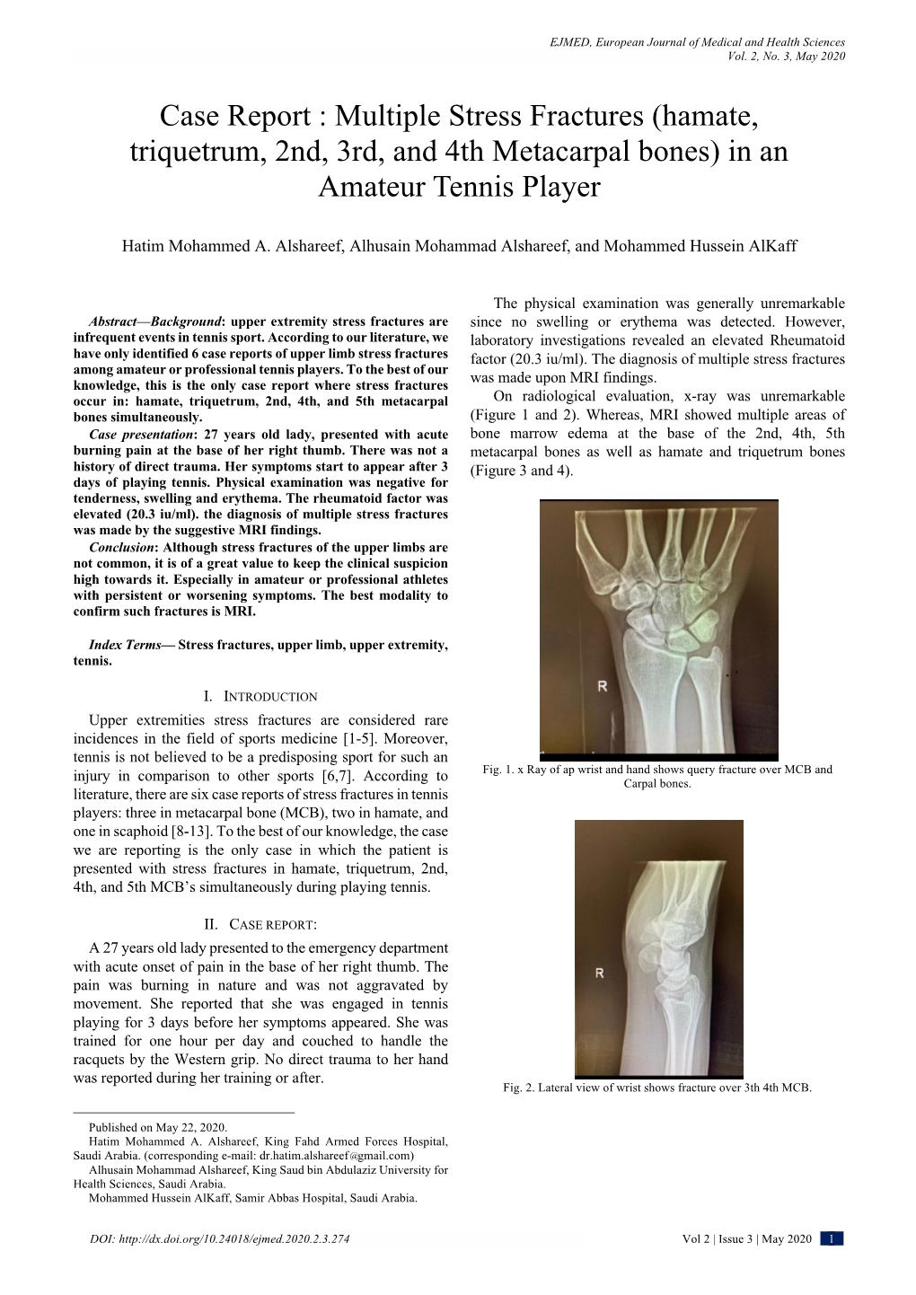 Case Report : Multiple Stress Fractures (Hamate, Triquetrum, 2Nd, 3Rd, and 4Th Metacarpal Bones) in an Amateur Tennis Player