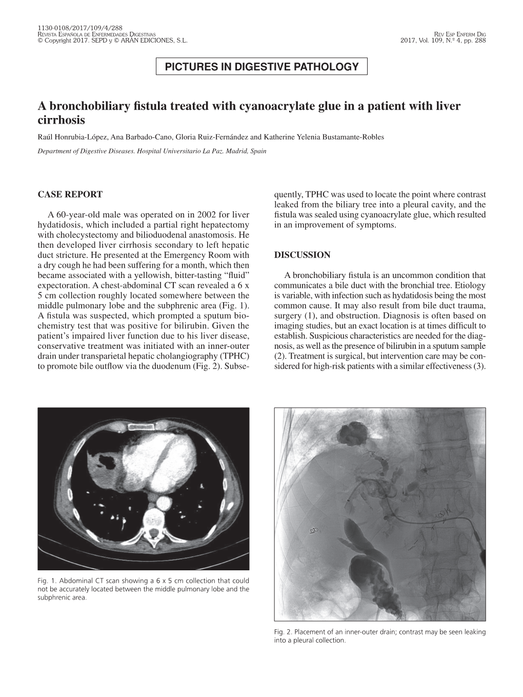 A Bronchobiliary Fistula Treated with Cyanoacrylate Glue in a Patient With