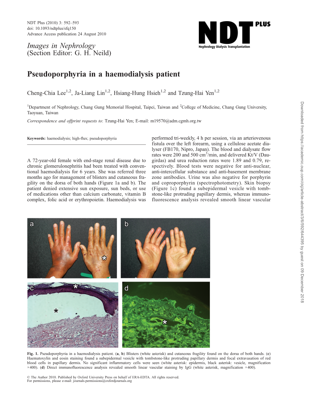 Pseudoporphyria in a Haemodialysis Patient